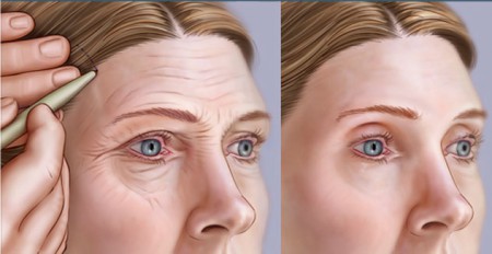 Aplicación de Botox